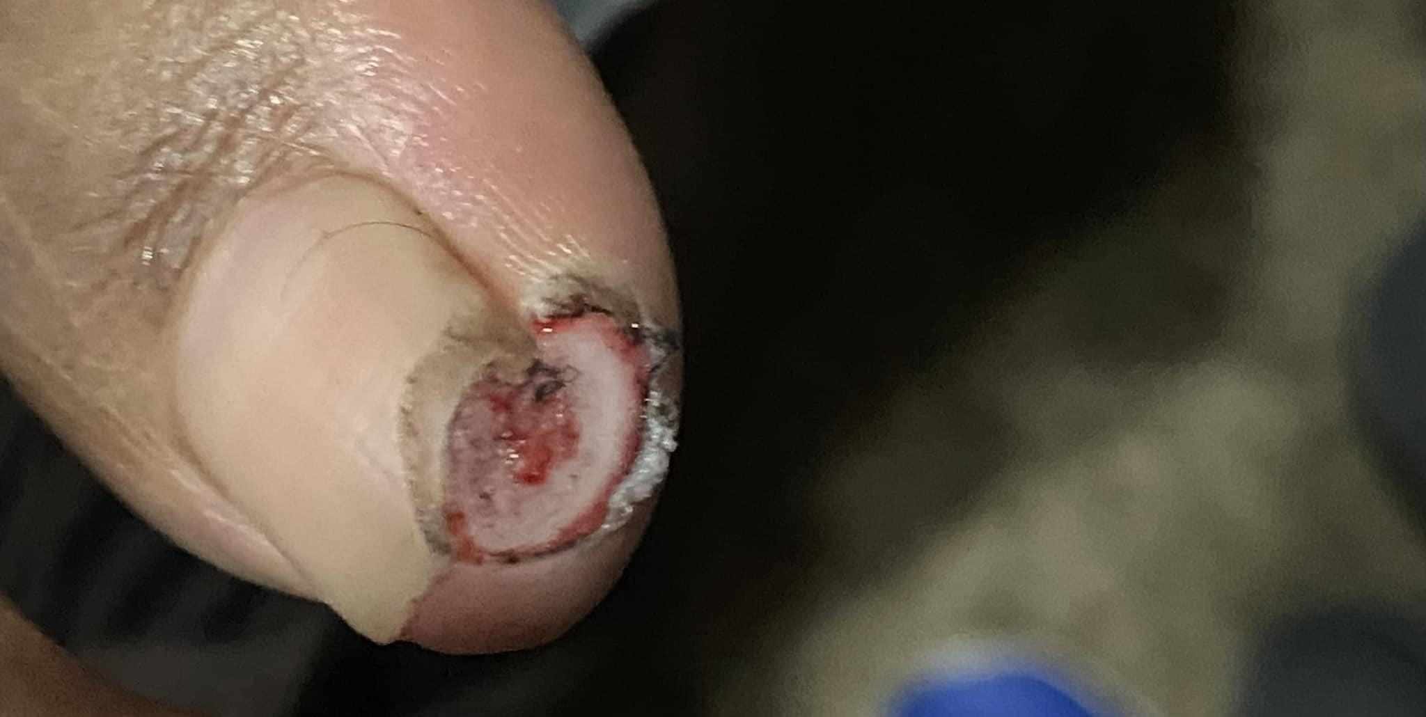 Chris Garner Jones Toe Injury