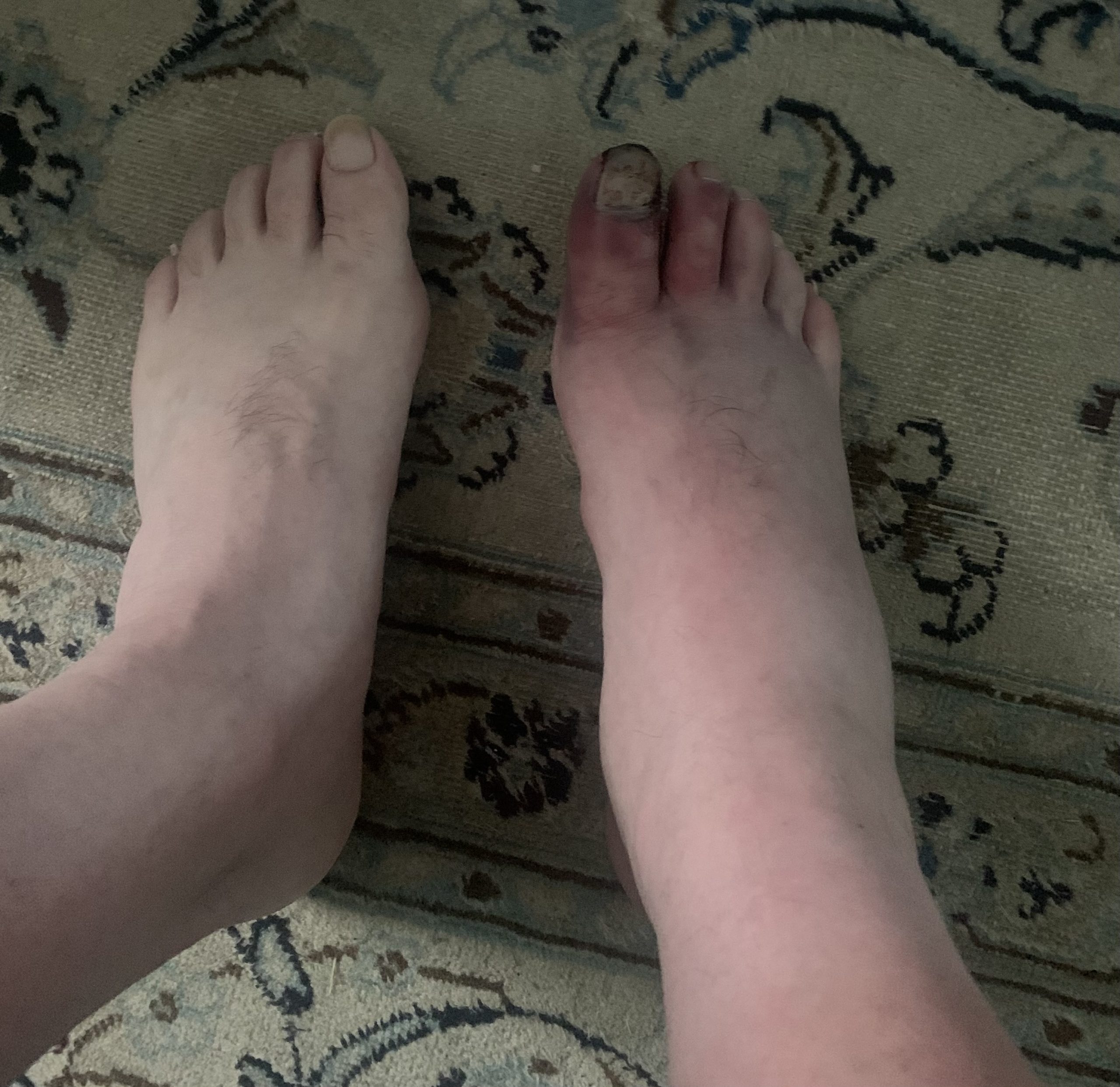 Dave Vantine Foot Injury 